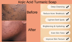 Kojic Acid Dark Spot Remover and Turmeric Honey Citrus Soap